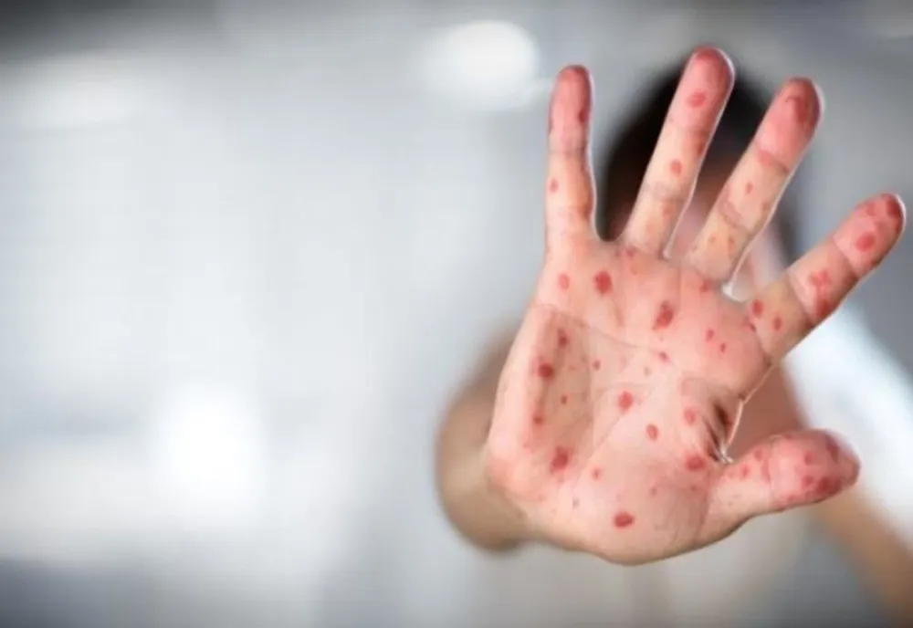 Ministerul Sănătății a declarat epidemie de rujeolă la nivel național