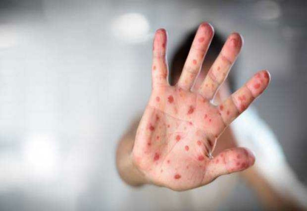 CREȘTEREA CAZURILOR DE RUJEOLĂ ÎNGRIJOREAZĂ AUTORITĂȚILE